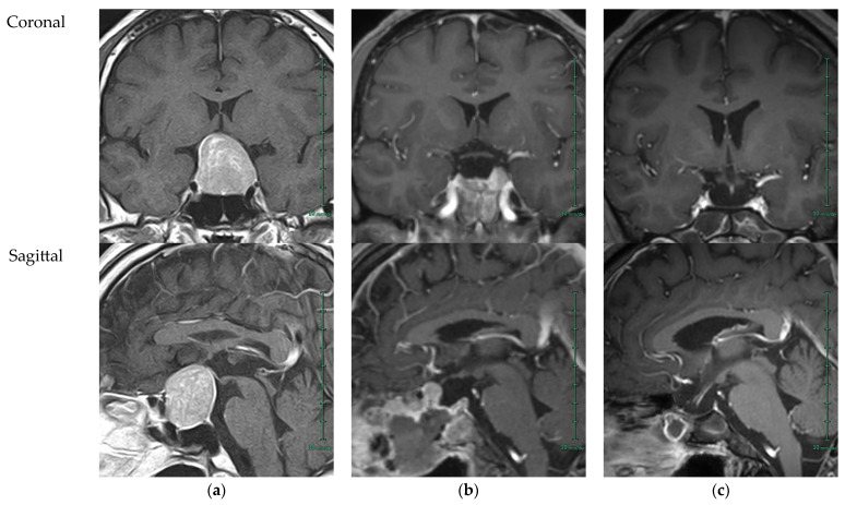 Comprehensive Fertility Management After Pituitary Adenoma Surgery: Lessons from a Rural Japanese Case and Practical Review.