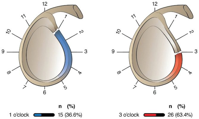 Effect of ALPSA Tear Morphology on Redislocation Risk After Arthroscopic Repair.
