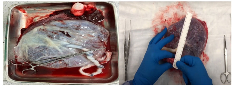 Impact of Sociodemographic, Clinical, and Genetic Factors and <i>Fusobacterium nucleatum</i> on Premature Birth Outcomes in Women from Kazakhstan: A Case-Control Study.