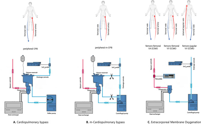 Intraoperative extracorporeal life support in tracheal surgery: a 20-year single-center experience.