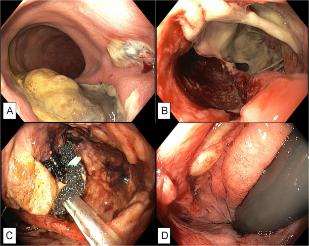 Accidental formaldehyde injection during prostate biopsy: a rare cause of rectal necrosis and perforation. Case report and review of the literature.