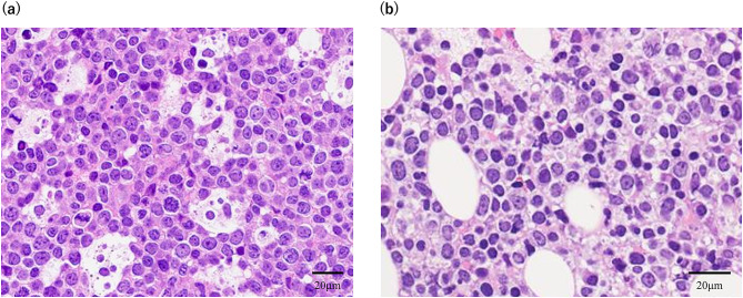 Severe hypercalcemia requiring emergency hemodialysis and multidrug therapy in a case of diffuse large B-cell lymphoma with multiple bone lesions.