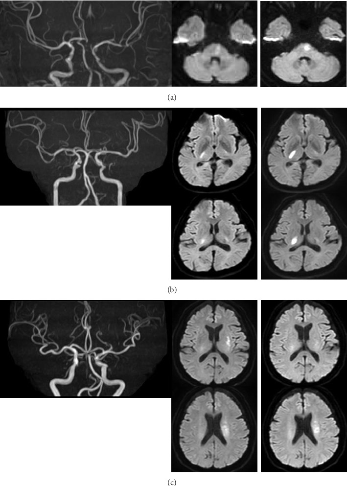 Administration of Cilostazol Prior to Intravenous Alteplase for Acute Branch Atheromatous Disease: A Report of Three Cases.