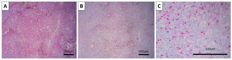 Melanotrichoblastoma: A Histopathological Case Report of a Rare Pigmented Variant of Trichoblastoma.