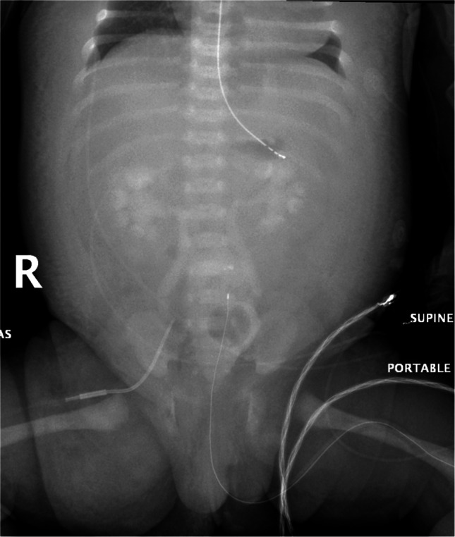 Incidence and factors associated with serosal and soft tissue enhancement after cardiac catheterization in infants.