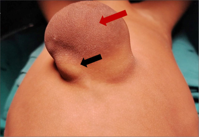 Mind the right ventricle: Tackling right heart dysfunction in left ventricular diverticulum with omphalocele.