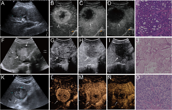 Contrast-enhanced ultrasound for diagnosing subtypes of intrahepatic cholangiocarcinoma: a comparative study with poorly differentiated hepatocellular carcinoma.