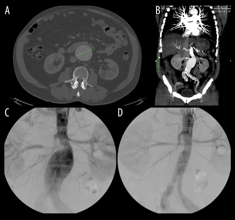 Aorto-Duodenal Fistula After Emergency Endovascular Repair of a 14-cm Abdominal Aortic Aneurysm in a 68-Year-Old Man.