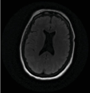 Delayed Posthypoxic Leukoencephalopathy in a Catatonic-Appearing Patient: A Case Report.