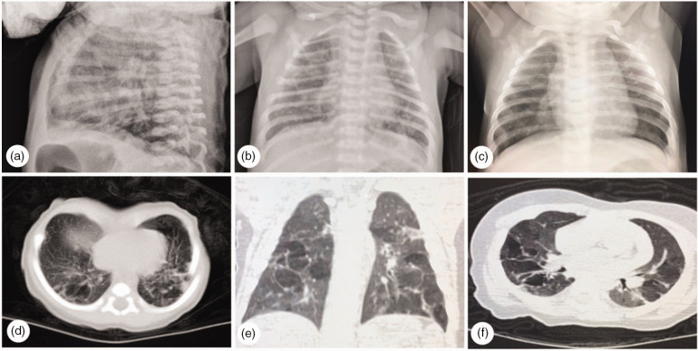 Beneath a silent attack: Unraveling lung and brain injuries in a surviving monoamniotic twin.