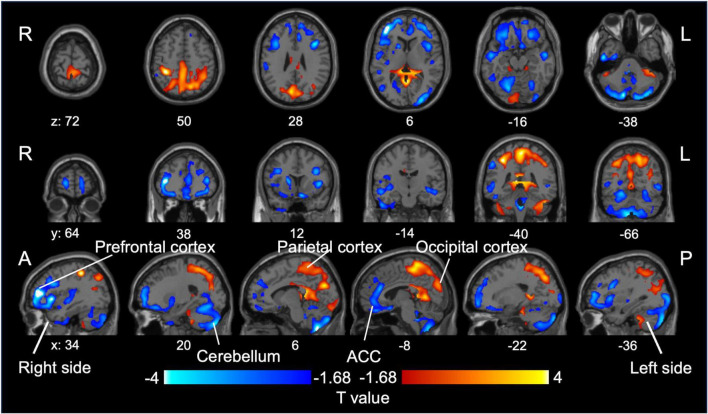 Differentiation between bipolar disorder and major depressive disorder based on AMPA receptor distribution.