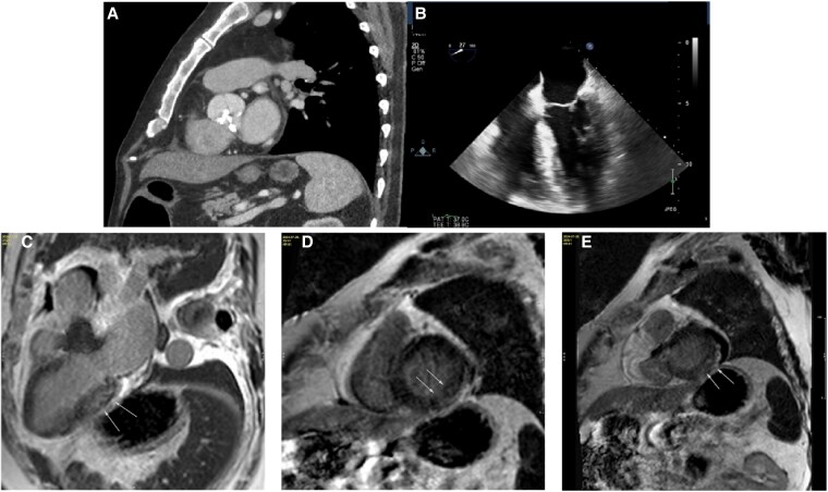 Case report of isolated aortic valve AL-amyloidosis following aortic valve replacement.
