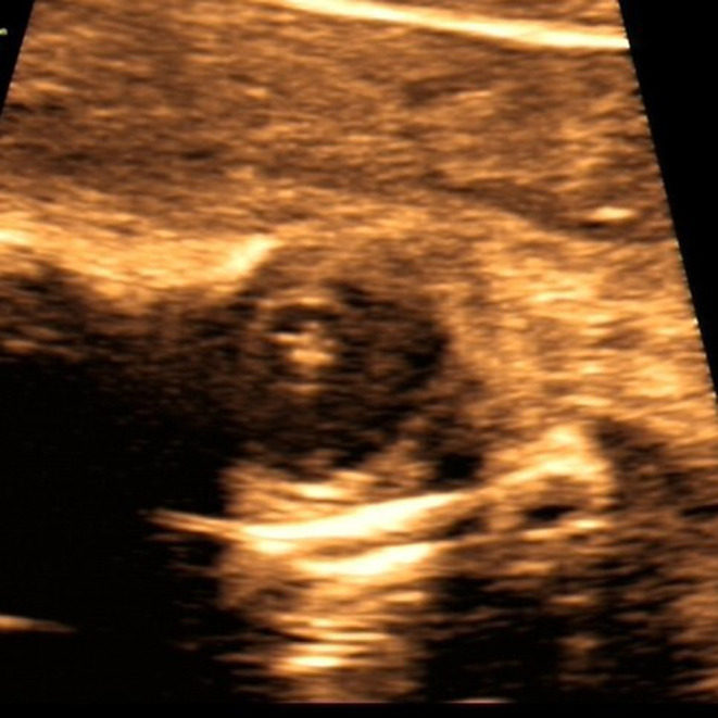 Prenatal Ultrasound Diagnosis and Prognosis Analysis of Fetal Congenital Cataract.