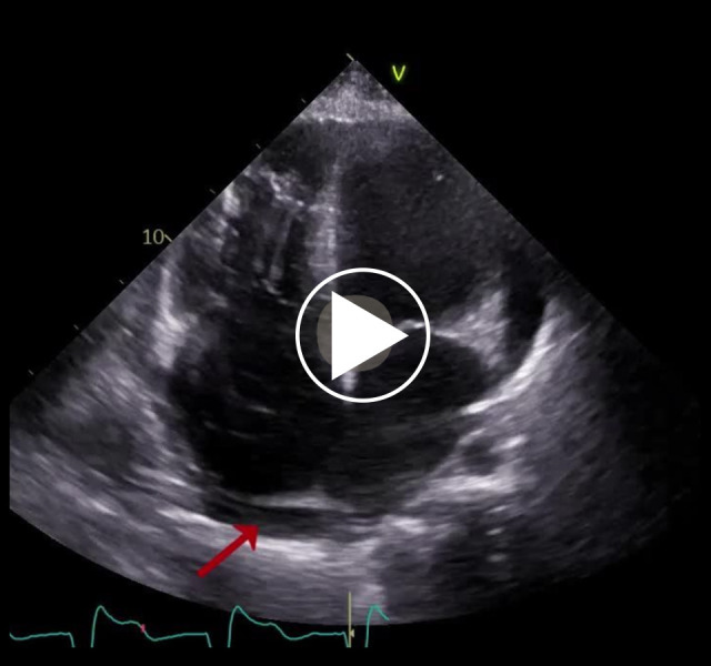 Crucial Role of Early Detection in Managing Heart Failure in Kearns-Sayre Syndrome: A Case Report.