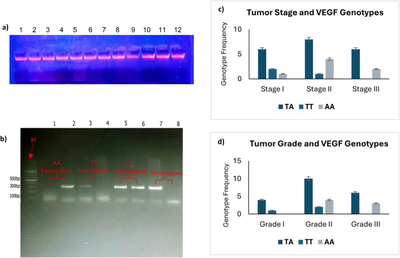 Association between VEGF gene polymorphisms and breast cancer risk.