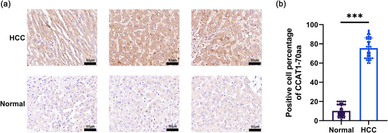 Peptide CCAT1-70aa promotes hepatocellular carcinoma proliferation and invasion via the MAPK/ERK pathway.