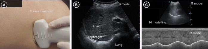 Diaphragm ultrasound for predicting weaning success in post-cardiac surgery acute respiratory distress syndrome patients: a prospective observational study in China.