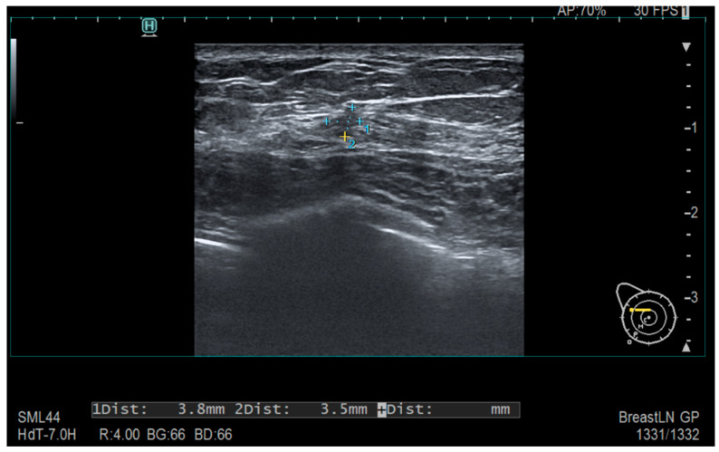 Therapeutic Patterns and Surgical Decision-Making in Breast Cancer: A Retrospective Regional Cohort Study in Romania.