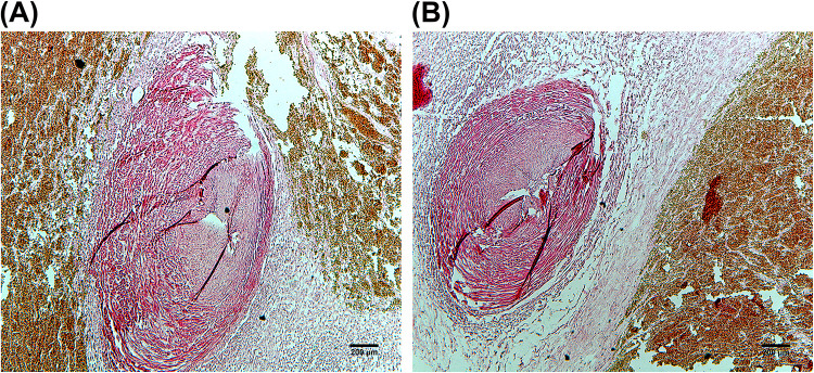 Fatal Umbilical Cord Hemorrhage Triggering Neonatal Demise: Clinicopathological Insights from the Case Analysis.