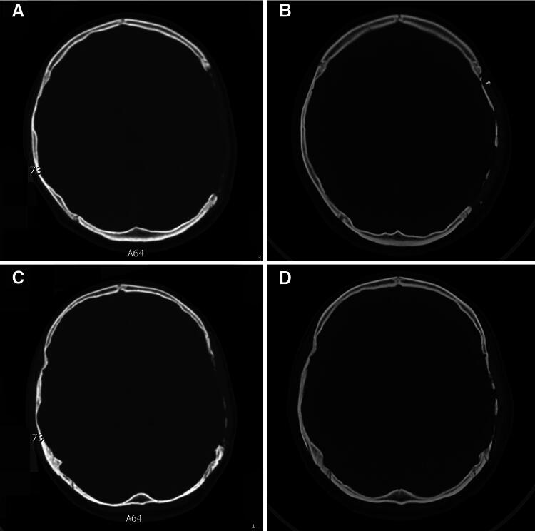 Gap Expansion Between Cranial Bone and Polyether Ether Ketone Implant in Cranioplasty of Pediatric Patients after Decompressive Craniectomy at Follow-up.