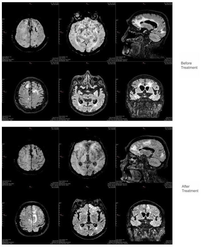 Cerebral inflammatory amyloid angiopathy: response to treatment.