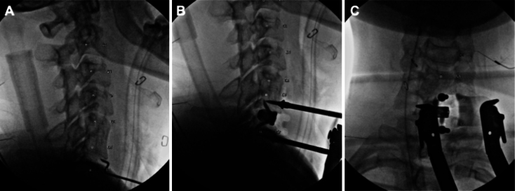 Multidisciplinary management of cervical disc herniation in pregnancy: illustrative case.