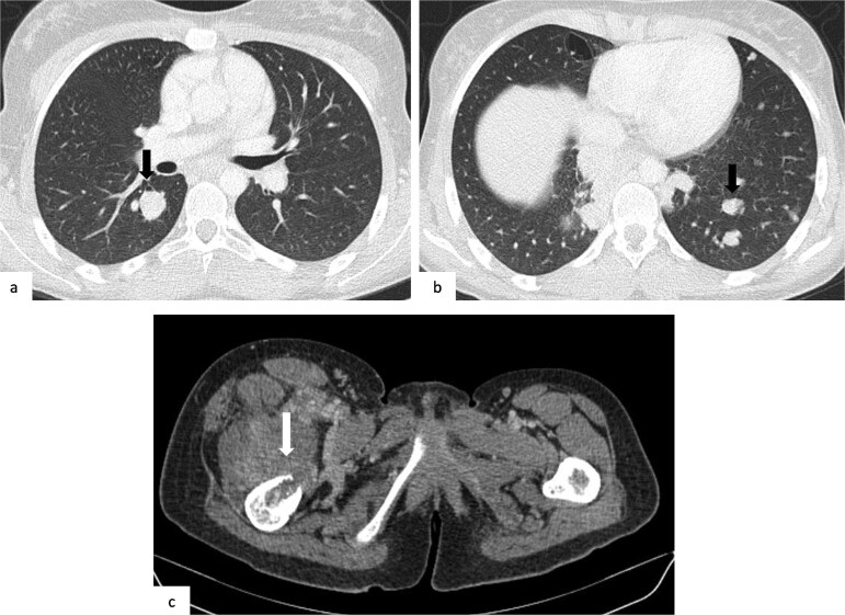 Hemorrhagic brain metastasis as the initial presentation of osteosarcoma: a rare case report.