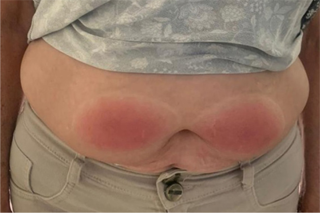 When Skin Reactions Interrupt Bone Therapy: Severe Cutaneous Adverse Reaction to Romosozumab Leading to Treatment Discontinuation.