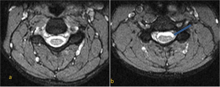 Hirayama disease: a rare cause of cervical myelopathy.