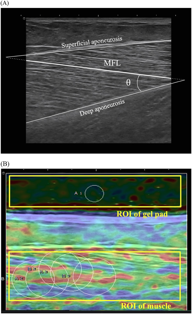 Dose-response effectiveness of focused shockwave therapy on ultrasonographic muscular properties in patients with stroke exhibiting ankle spasticity.