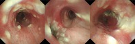 Tracheobronchial Tuberculosis During Treatment for Bronchial Asthma.