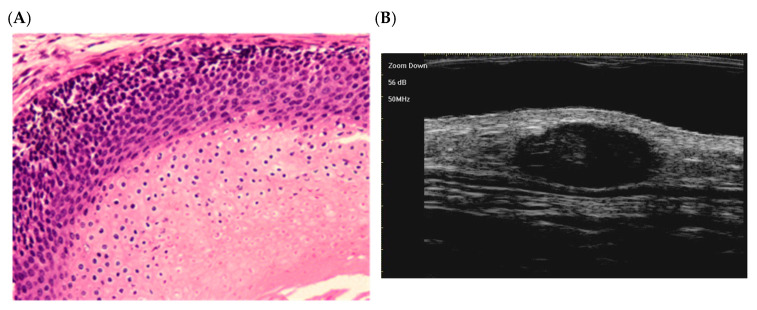 Pilomatricoma in Syndromic Contexts: A Literature Review and a Report of a Case in Apert Syndrome.