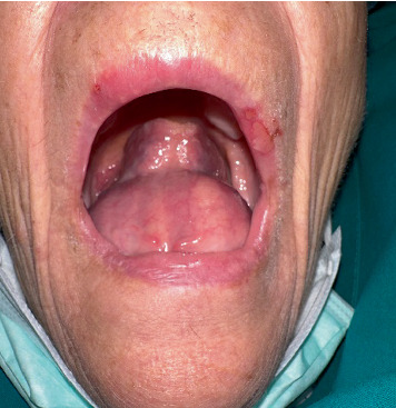 Oral Dermoid Cyst in the Mouth Floor: A Case Report and 5-Year Review of the Literature.