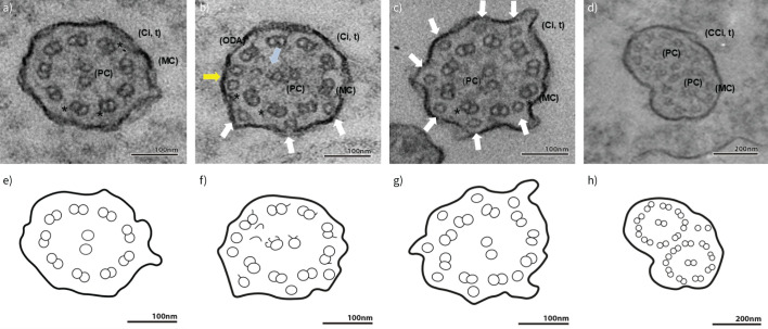 A 28-year-old woman with chronic respiratory symptoms: navigating a diagnostic puzzle.