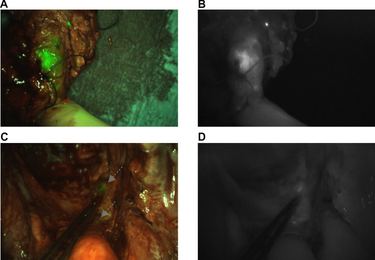 Long-term Local Control Following CEA-targeted Fluorescence-guided Surgery in Patients With Locally Advanced and Recurrent Rectal Cancer.