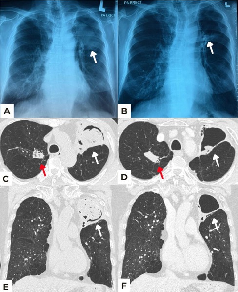 Successful Treatment of Aspergilloma With Antifungal Alone: A Case of Conservative Management.