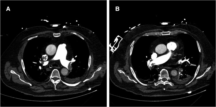 In-hospital cardiac arrest due to acute pulmonary embolism: a case report of successful catheter-directed thrombectomy on a patient with VA-ECMO.