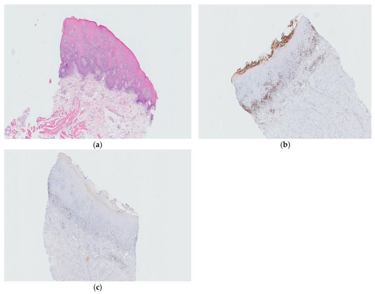 Chronic Hyperplastic Candidiasis-An Adverse Event of Secukinumab in the Oral Cavity: A Case Report and Literature Review.