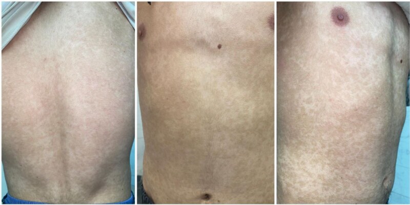 Challenges in diagnosing confluent and reticulated papillomatosis: a case of atypical lesions distribution.