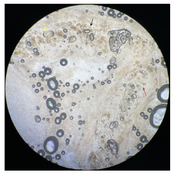 Umbilical Scabies.