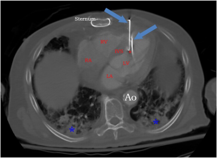 Conservative non-surgical management of penetrating cardiac injury with three retained metal nails: a case report.