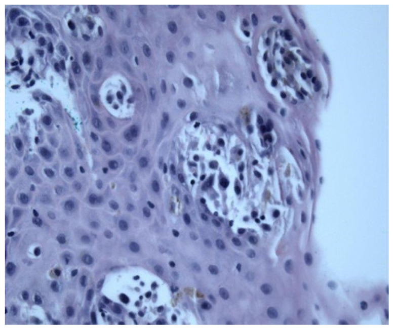 Disseminated Melanoma with Extensive Gastrointestinal Tract Involvement: Incidental Detection of Metastases on Upper Endoscopy.