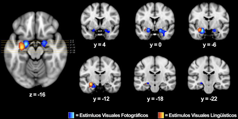 [Study of Successful Emotional Memory Encoding with Functional Magnetic Resonance Imaging: A Meta-Analysis Comparing the Affective Salience of Words Versus Images].