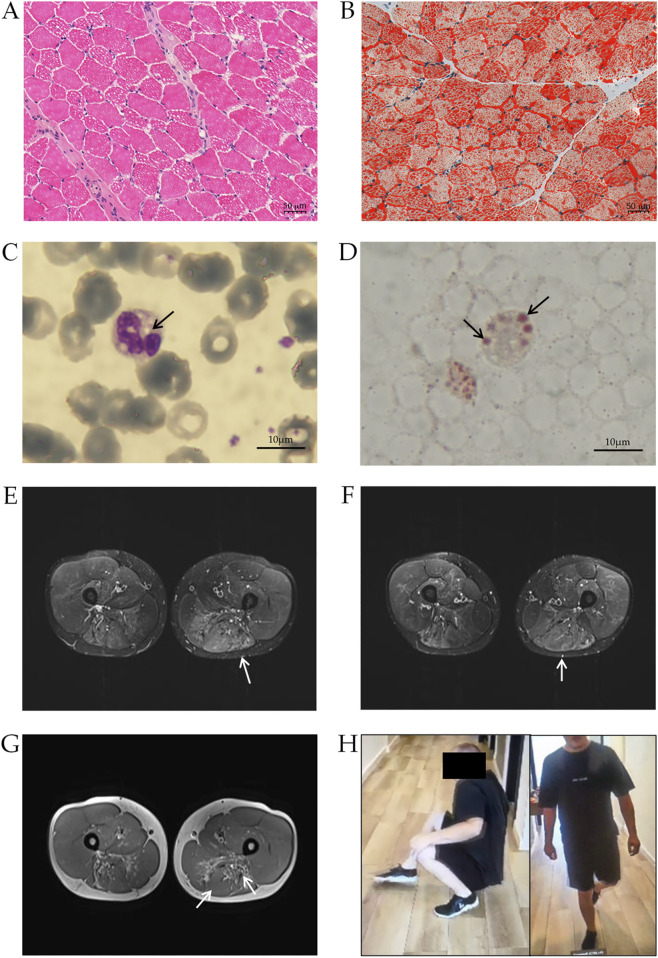 Case Report: Pathogenic <i>PNPLA2</i> variants and nonsense-mediated mRNA decay result in an early-onset neutral lipid storage disease with myopathy.