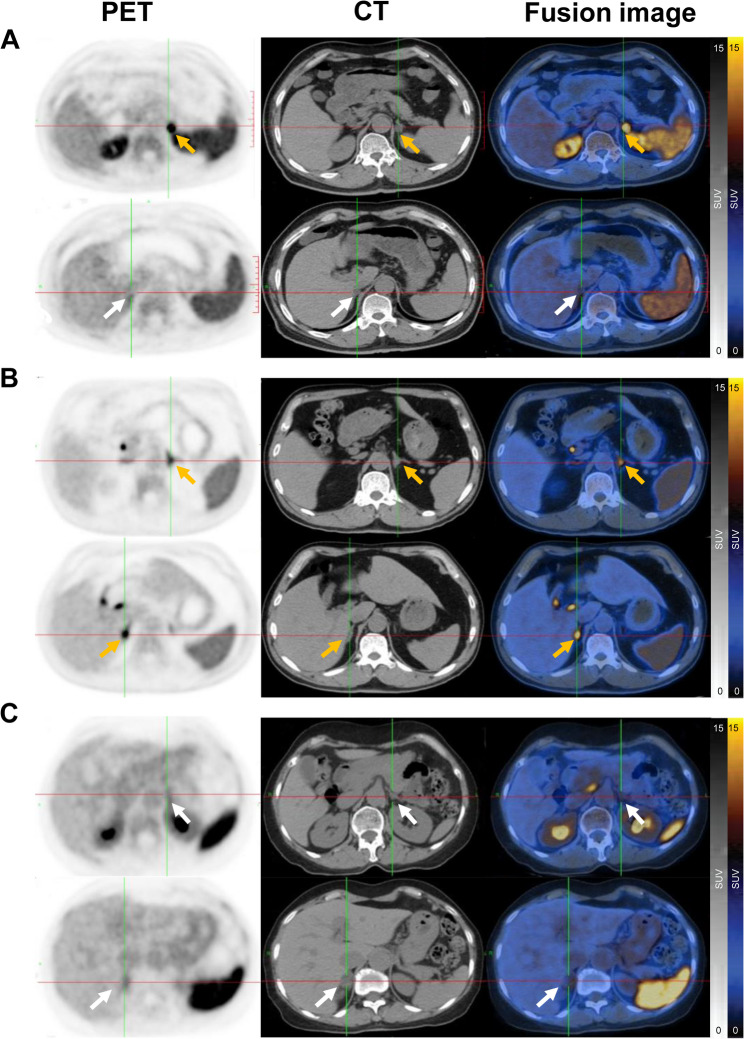 Is CXCR4-targeted <sup>68</sup>Ga-pentixafor PET/CT a reliable AVS-free modality for surgical decision-making and prognostic prediction in primary aldosteronism with bilateral adrenal lesions?