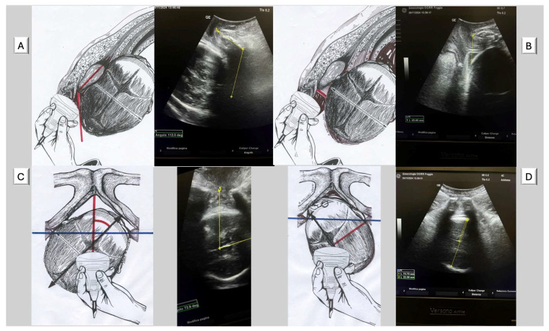 The Contribution of AIDA (Artificial Intelligence Dystocia Algorithm) to Cesarean Section Within Robson Classification Group.