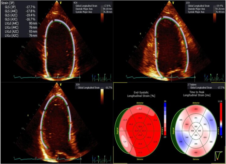 Reliability of left ventricular global longitudinal strain across acquisition and analysis techniques: a prospective comparative study.