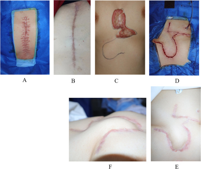 Retrospective study comparing three approaches for keloids: surgery + radiotherapy, surgery + pharmacological injection, and surgery alone.