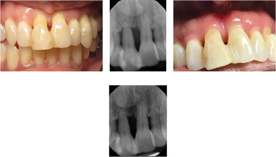 Maintenance of Periodontally Compromised Teeth Using Periodontal Splints.