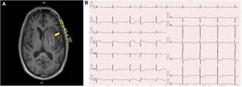 Concurrent inferior stemi with third-degree AV block and acute intracranial haemorrhage: how we overcame this clinical challenge-a case report.